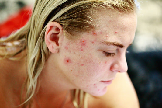 Let's Find Out The Root Causes Of Having Acne