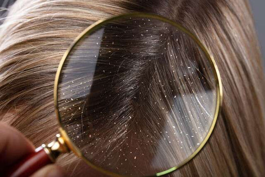 Dandruff: Learn How to Treat it Naturally?