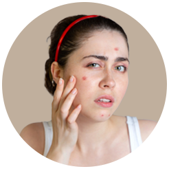 <strong>Acne & Pimples</strong>