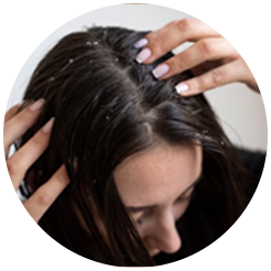 <strong>Dandruff</strong>