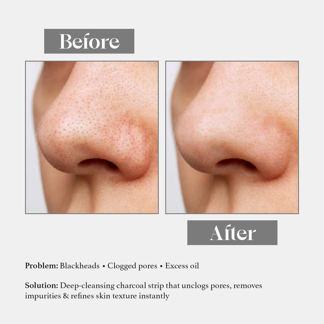 Charcoal Nose Strips for Blackheads and Whiteheads | With witch hazel| Suitable for all skin types