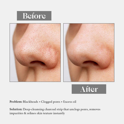 Charcoal Nose Strips for Blackheads and Whiteheads | With witch hazel| Suitable for all skin types
